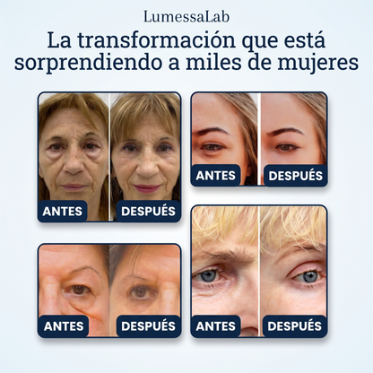 TensorEye™ – Elimina Ojeras y Bolsas